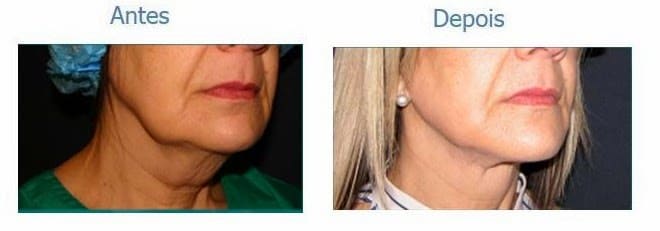 Compare o antes e depois de uma paciente que confiou a sua lipoaspiração da face e pescoço ao Dr. Seixas-Martins
